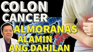 Colon Cancer, Almoranas, Alamin ang Dahilan: Paano Maiiwasan - Payo ni Doc Willie Ong #295c