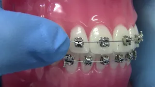 How to Manage a Open Bracket (Orthodontic emergency)