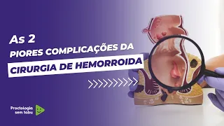 As 2 piores complicações da cirurgia de hemorroidas!