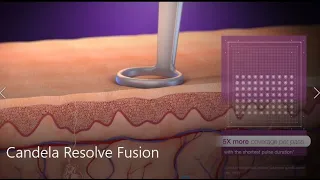 Acne, Scar and Wrinkle Treatment by Candela (3D medical animation)