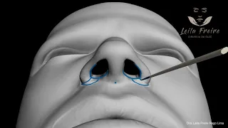 Rinoplastia redução da base nasal