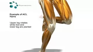ACL Tear (Sports Injury)