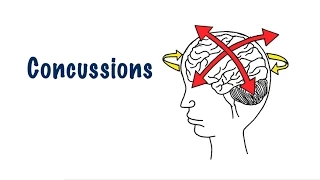 Concussions in sports and return to play protocol