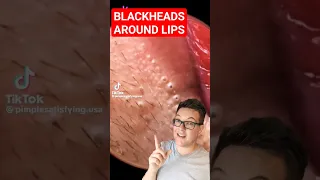 ❌YOUR LIP BALM IS CAUSING THIS - Blackhead Removal Around Lips #shorts