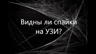 Видны ли спайки на УЗИ? На видео представлены рыхлые спайки в малом тазу при УЗ-исследовании.