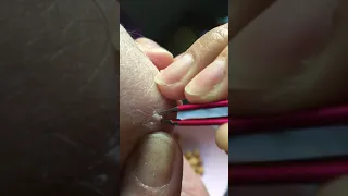 Big pus pimple boil