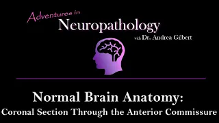 Normal Neuro Anatomy - Coronal Section of the Brain Through the Anterior Commissure