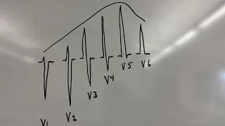 What is R wave progression?