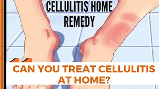 Can You Treat Cellulitis at Home? | cellulitis home remedy