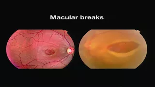 AIOC2018 -  IC248 - Ocular Trauma: Manifestation and treatment