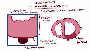 Heart attack acute myocardial infarction   causes, symptoms, diagnosis, treatment, pathology