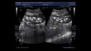 Ultrasound Video showing bilateral Medullary nephrocalcinosis and renal calculi.