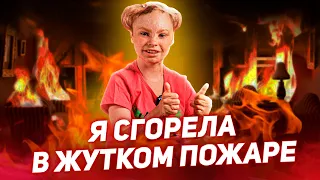 🔥 Я СГОРЕЛА В ЖУТКОМ ПОЖАРЕ / ИСТОРИЯ АЛЕСИ ПЕТРАКОВОЙ [Добрый Волшебник]