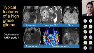 Clinical Advances of Perfusion MRI in the Current Neuro-oncology Landscape