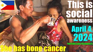 This Filipina has Bone Cancer and She's in Terrible Agony. Life of Filipinos in the Philippines. PH