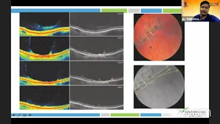 AIOC2021-GP121-Topic-Dr.Thirumalesh- Retinal Peripheral Degenerations and Refractive Surgery