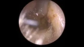 Ear Wax Removal in  Shaky  Head   By Doctor Rada