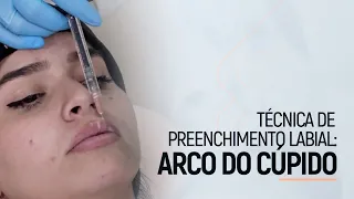 Técnica de Preenchimento Labial: Arco do Cupido | Dra. Bruna Almeida