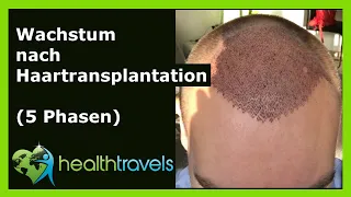 Wachstum nach Haartransplantation [5 Phasen] - Health Travels informiert