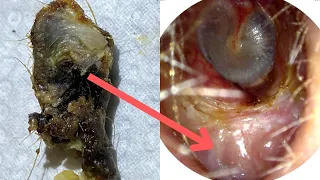 150 - Huge Ear Wax Plug Extracted from Ear Crater due to Benign Osteonecrosis using WAXscope®️