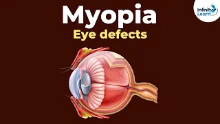 Eye defects - Myopia | Don't Memorise