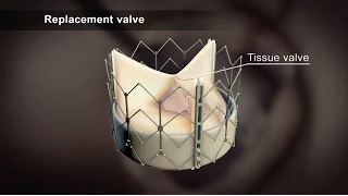 TAVI (Transcatheter Aortic Valve Implantation)