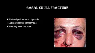 Orbital trauma by Dr shoaib Akram lecture 11 Class 4th year