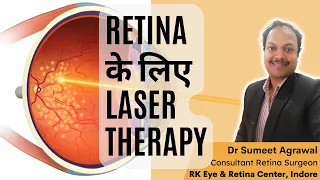 Retina का LASER treatment. क्यों करते हैं ? कब और कैसे करते हैं ?