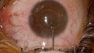 Implantación de lente Intraocular ARTIFLEX - Corrige Miopía y Astigmatismos Altos