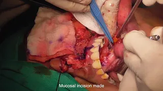 total maxillectomy