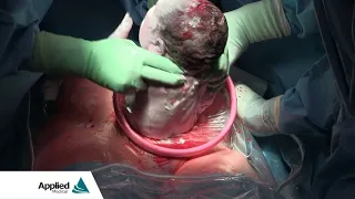 Cesarean Section | Featuring the Alexis® O C-Section Protector-Retractor