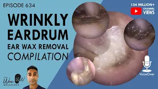 634 - Wrinkly Eardrum Ear Wax Removal Compilation