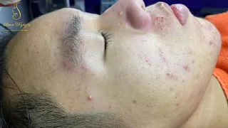 Blackheads removal (311) | Loan Nguyen