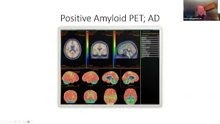 11/3/2023 - Monoclonal Antibody Treatments for Alzheimer's: the Good, the Bad, and the Difficult