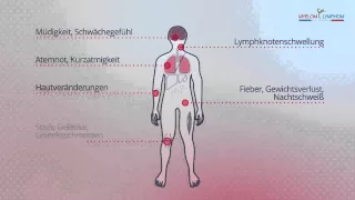 Symptome bei Lymphomerkrankungen