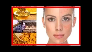 Home Remedies für Rosacea