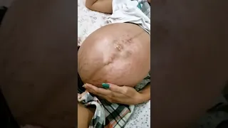 7mos into TWIN PREGNANCY