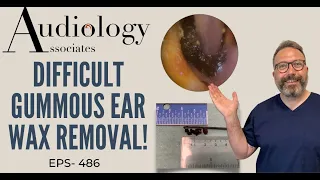 DIFFICULT GUMMOUS EAR WAX REMOVAL - EP486