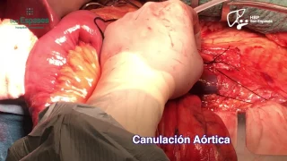 Liver procurement technique in cadaveric donor for transplant.