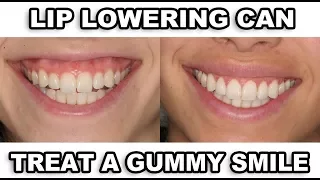 Gummy Smile Correction (REAL RESULTS!!)