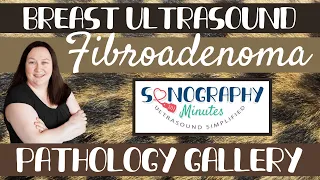 Breast Ultrasound Pathology Gallery | Fibroadenoma | Sonography Minutes