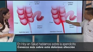 Causas y síntomas de la apendicitis [HOY EN SALUD]