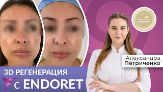 3D Регенерація з ENDORET