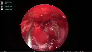 ANTERIOR CLINOID MUCOCELE /ONODI CELL MUCOCELE