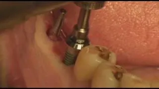 Dentium dental Implant Prosthetic#46,47 IS (3''09)