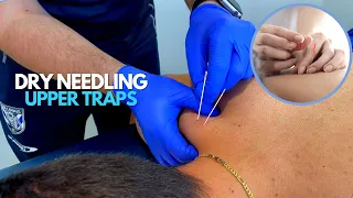 Upper Traps Dry Needling | Pain Relief