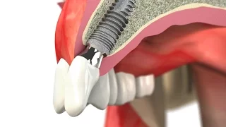 SIC invent Dental Implant: Wax-Up Single Tooth Crown