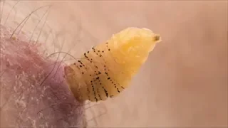 Researcher raises botflies under his skin I NOVA I PBS