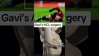 Gavi ACL surgery & meniscus repair. Expert explains. #barcelona #fcbarcelona #football #acl