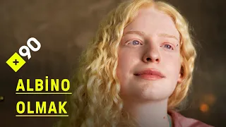 Albino olmak | "Gözlerim titrese de, kaysa da kameranın karşısındayım"